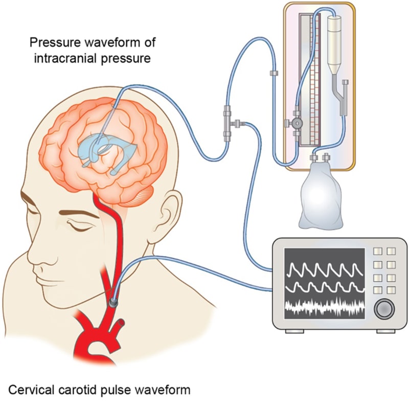 فشارسنج سنگین (Intracranial Pressure Monitoring)