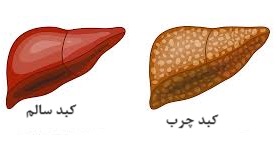 پیشگیری از کبد چرب: راهی به سوی سلامتی و زندگی بهتر