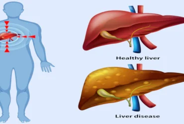 پیشگیری از کبد چرب: راهی به سوی سلامتی و زندگی بهتر