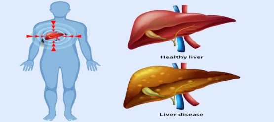 پیشگیری از کبد چرب: راهی به سوی سلامتی و زندگی بهتر